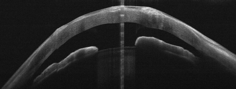 Keratite neuroparalytique