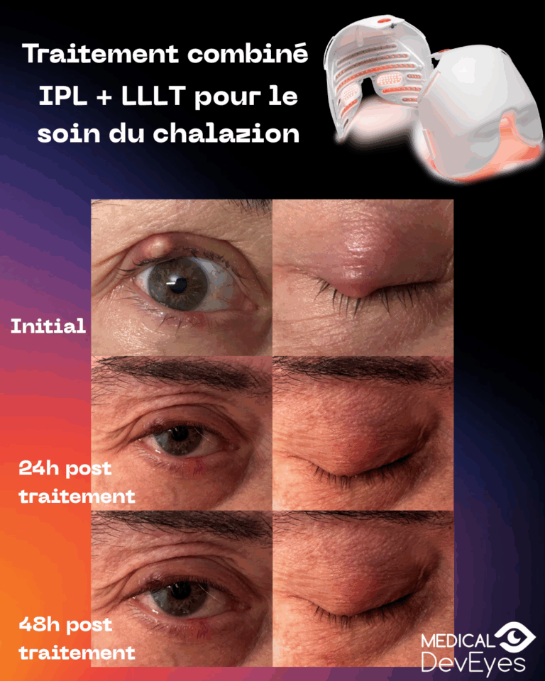 photobiomodulation chalazion
